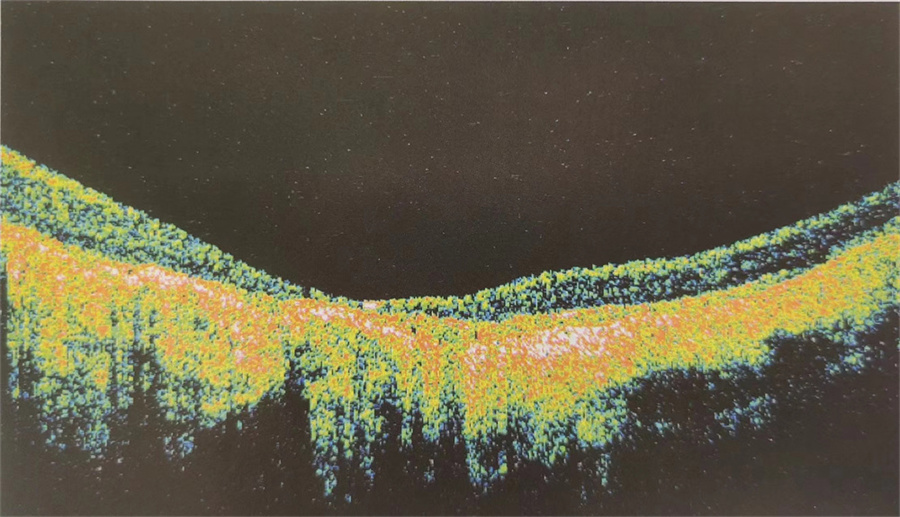 右眼年龄相关性黄斑变性OCT图像